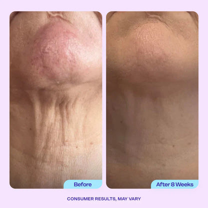 Stop hiding — restore the youthful power of your neck with GOPUCE